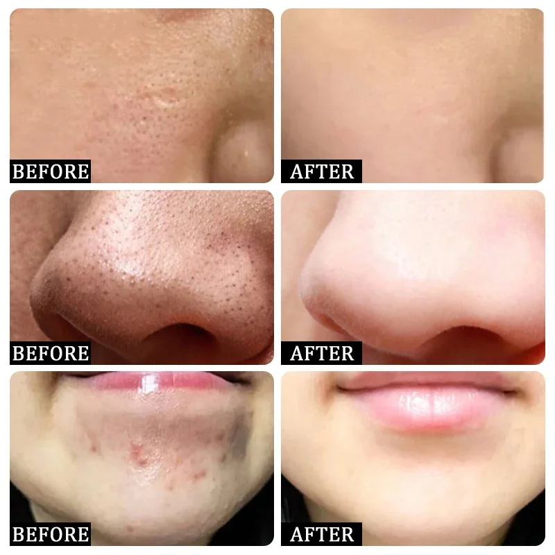 Salisilik Asit Gözenek Temizle - Korean Skincare Routine incelemesi ve fiyatı
